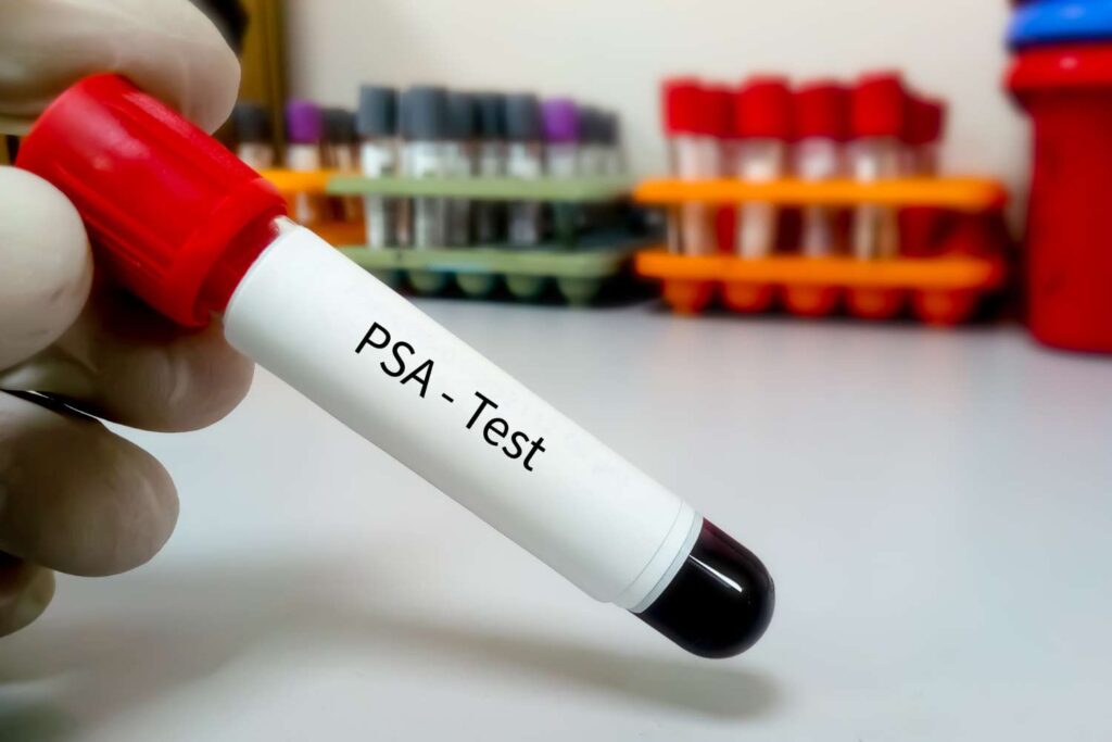 Prostate Specific Antigen PSA